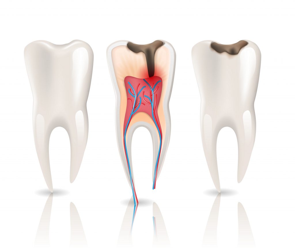 Caries infection causing tooth sensitivity