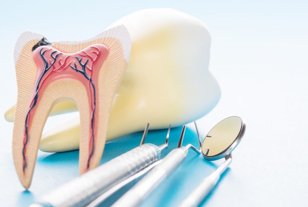 Root Canal Treatment for infected tooth pulp