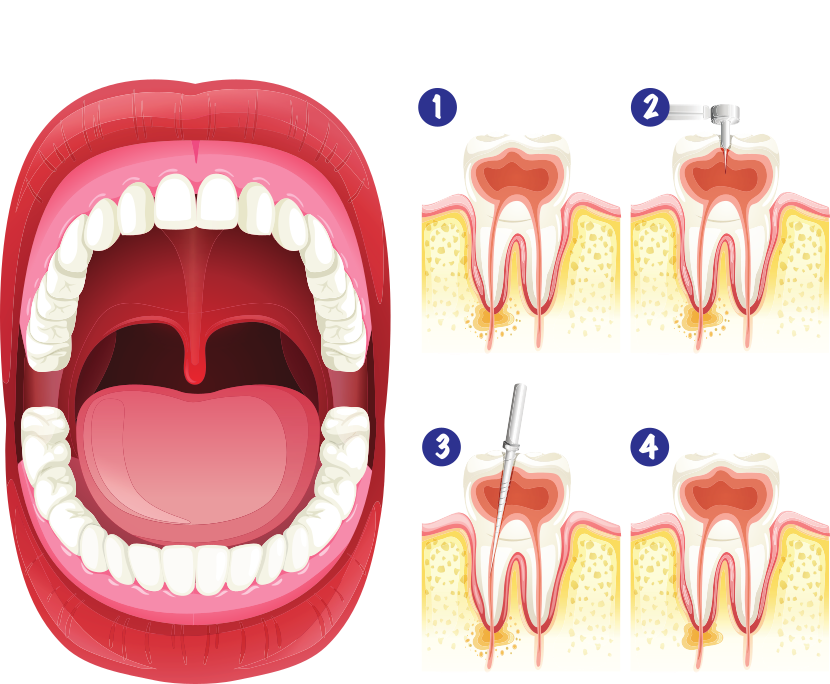 Root Canal Treatment