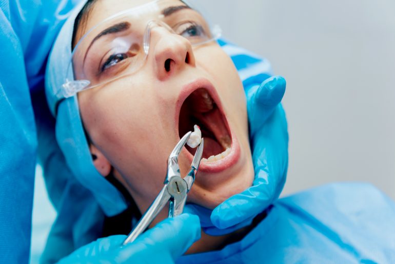 tooth extraction